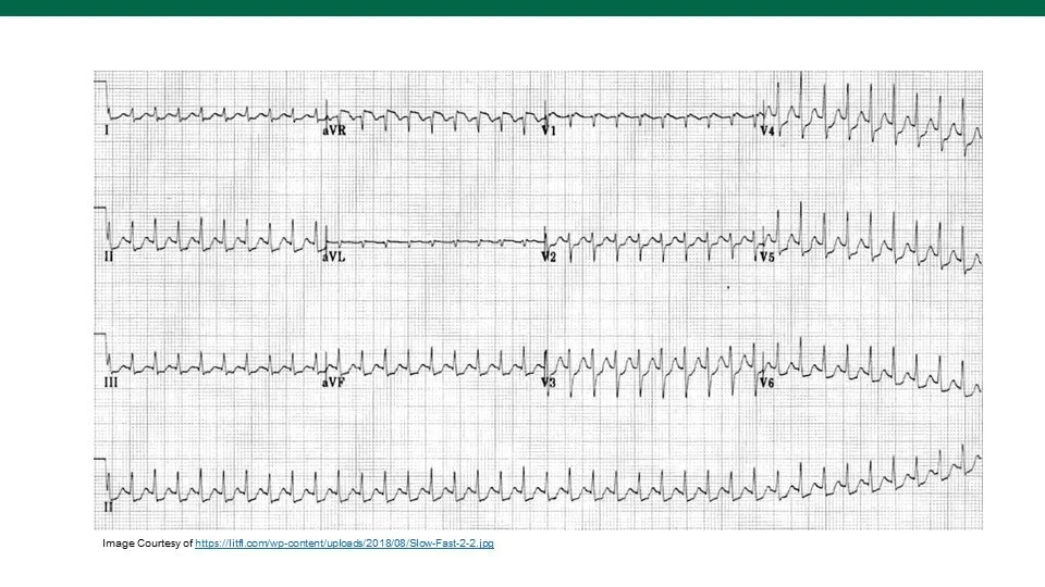 EPSとSVT Premature Atrial Contraction (Multiple) Vs. Supraventricular